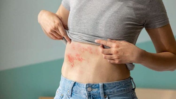 Apa itu Cacar Ular dan Bagaimana Gejalanya.jpg