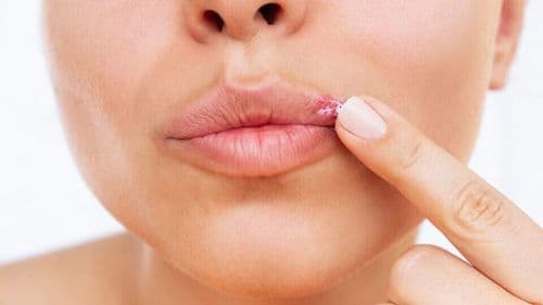 Herpes Simplex: Bagaimana Cara Penularannya?