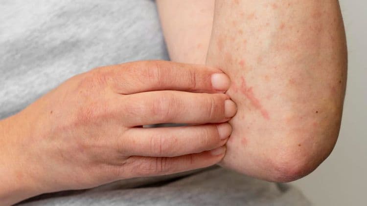 Apa itu Campak dan Bagaimana Penularannya.jpg