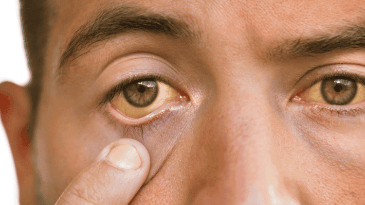 Kenali Hepatitis A - Penyebab, Tanda-Tanda dan Gejala.png