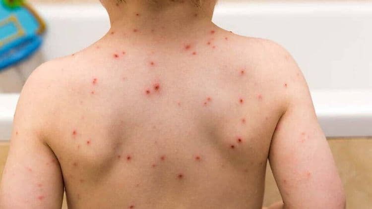 Mengenal Cacar Air dan Bagaimana Mencegah Penularannya.jpg