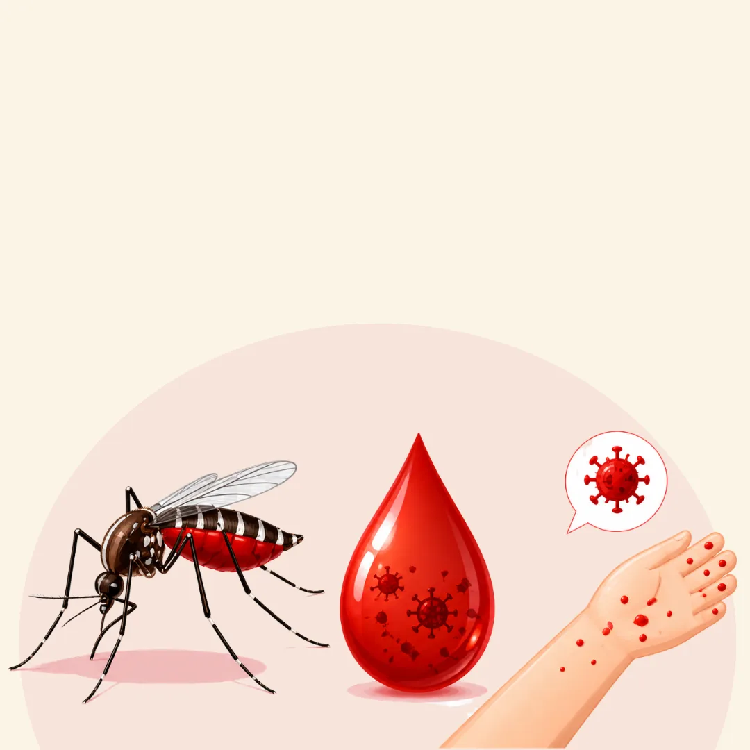 Demam Berdarah Dengue (DBD)